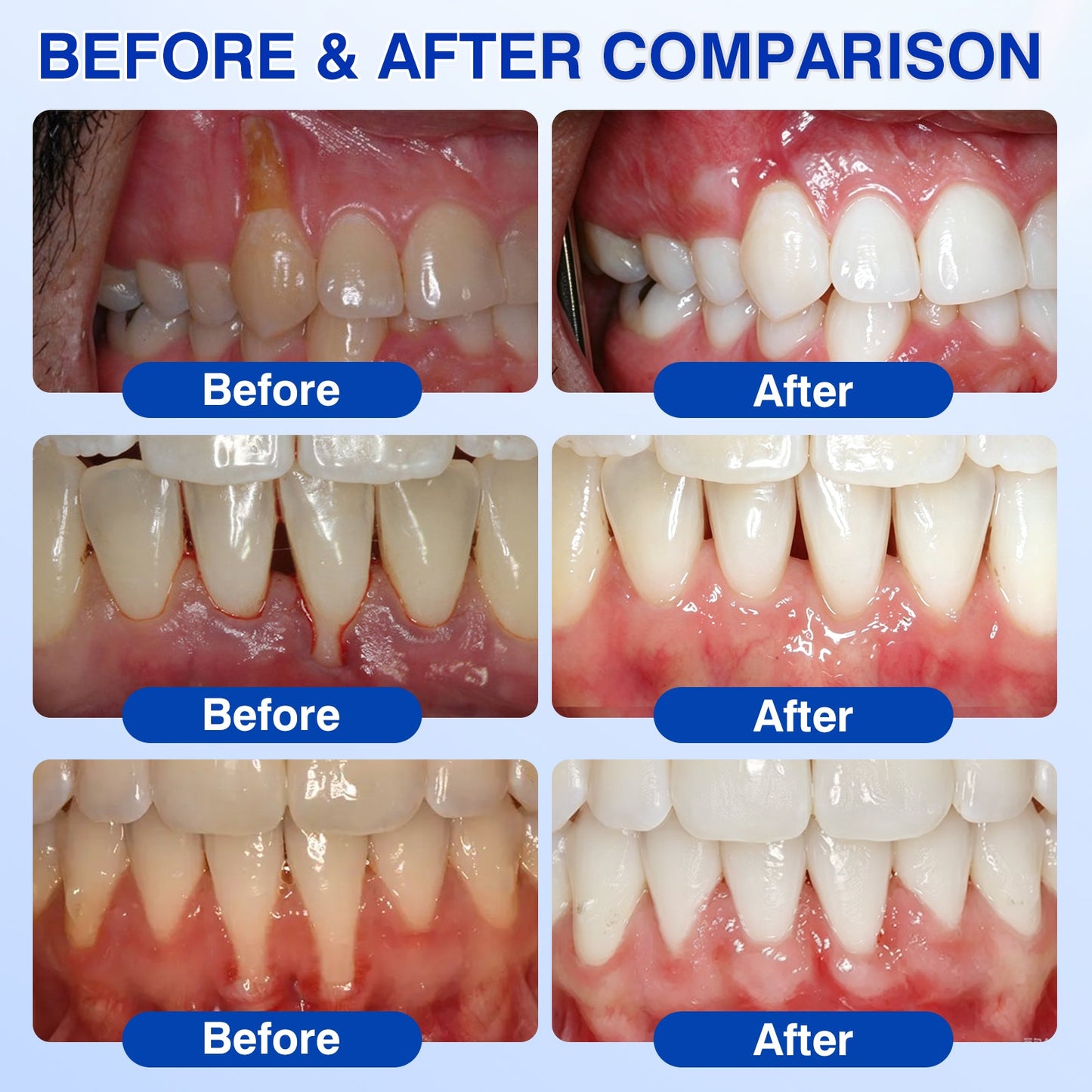 🦷𝐍𝐚𝐭𝐫𝐚𝐯𝐨𝐫® GumRevive Gum & Periodontal Care Gel