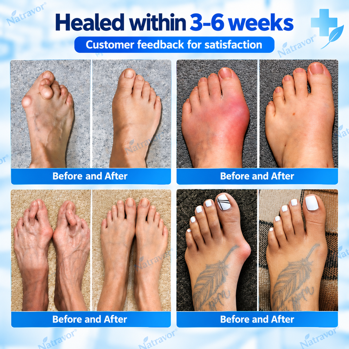 🏅Natravor® Relief Botanical Bunion Comfort Patcht👠💃（Physical Stretch Support + Botanical Comfort Formula)a