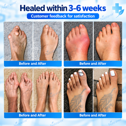 🏅Natravor® Relief Botanical Bunion Comfort Patcht👠💃（Physical Stretch Support + Botanical Comfort Formula)a